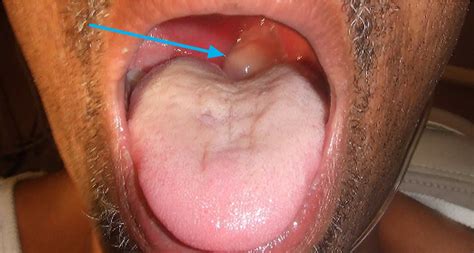Peritonsillar Abscess Causes Signs Symptoms Diagnosis And Treatment