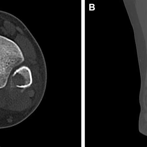 Pdf Solid Variant Aneurysmal Bone Cyst In The Distal Fibular