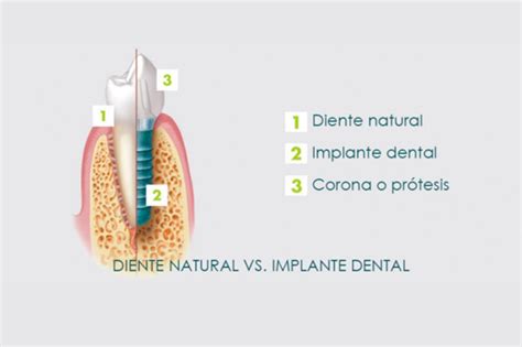Implantología Odus Sa Clínica Odontológica En Quilmes