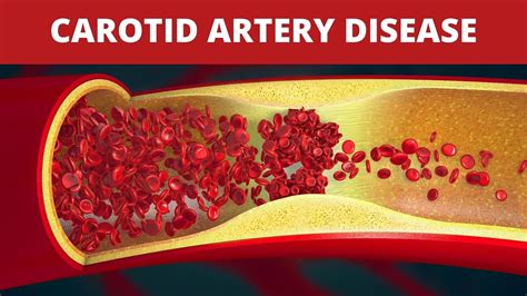 Treatment Of Carotid Artery Disease Youtube