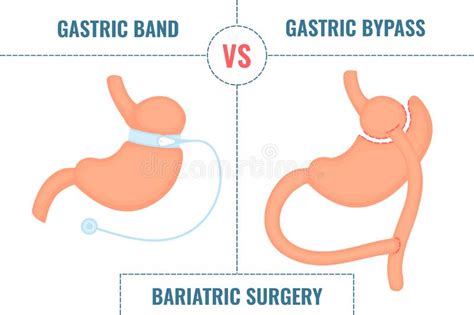Gastric Band Vs Gastric Bypass Bariatric Surgery Weight Loss