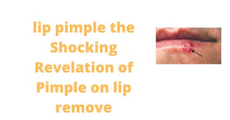 Lip Pimple Causes The Shocking Revelation Of Pimple On Lip Remove