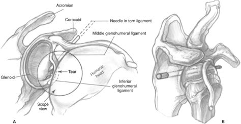 Shoulder Arthroscopy Musculoskeletal Key
