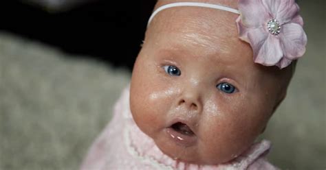 Do Babies With Harlequinn Ichthyosis Survive Blessed By Brenna Westlake