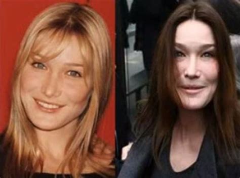 Shocking Cases Of Plastic Surgery Disasters Wtf Gallery Ebaum S World