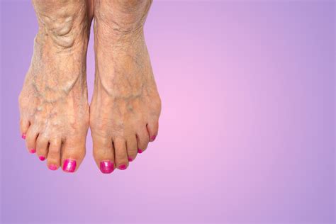 What Causes Varicose Veins Around The Ankles