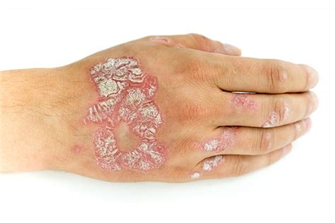 Types Of Mild Psoriasis Treatment Symptoms And Pictures