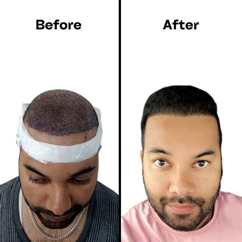 Best Hair Transplant Clinic In Amritsars Most Trusted Hair Transplant