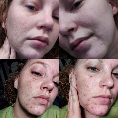 Before And After Going Vegan Acne Clear Up Vegan