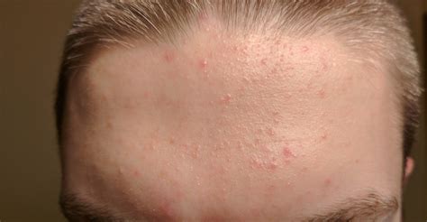Acne Advice On How To Remove Forehead Acne Skincareaddiction