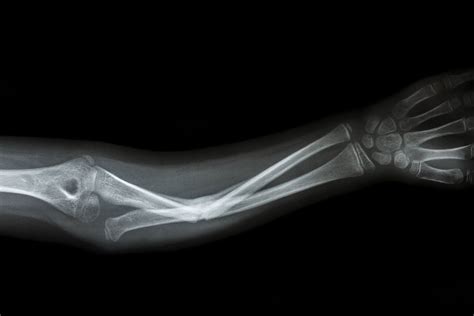 Depuy Synthes Elbow Implant Recall Lawsuit Scranton Pa