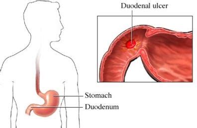 Duodenal Ulcer Ulcers Peptic Ulcer Body