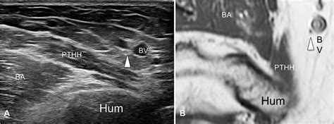 Sonography Of The Pronator Teres Normal And Pathologic Appearances