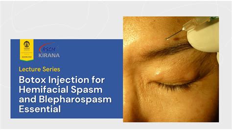 Neuro Ophthalmology Lecture Botox Injection For Hemifacial Spasm And Blepharospasm Essential