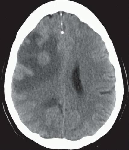 Cerebral Metastases Radiology Key