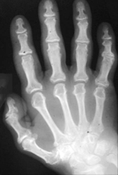 Radiograph Of A Hand In Moderately Advanced Acromegaly Showing A