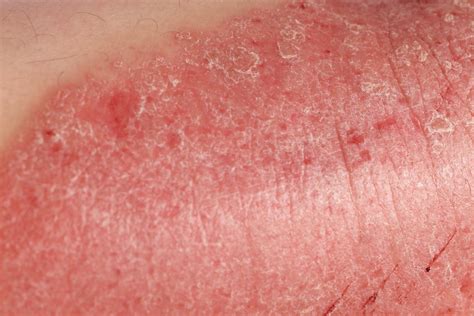 genital psoriasis what it is main symptoms and treatment