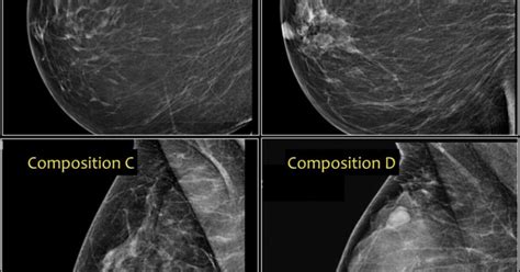 Mammogram Ultrasound Results