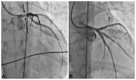 Coronary Angiography Cardiac Catheterization Images From Our Patient