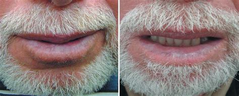 Actinic Cheilitis In The Lower Lip Before Left And After Right 2
