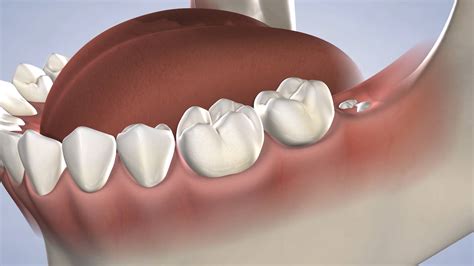 What Is The Purpose Of Wisdom Teeth Boston Dentist Congress Dental