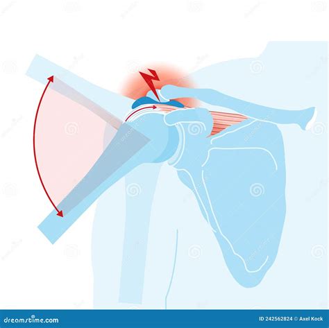 Shoulder Joint Shoulder Impingement Labeled Illustration Stock
