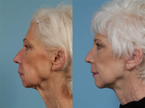 Neck Lift Before And After Pictures Case Chicago Il Tlkm Plastic Surgery