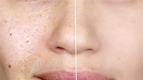 Enlarged Facial Pores Singhania Skin Clinic