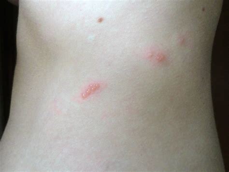 The Sexiest Blister Beetle Dermatitis On The Internet Flickr