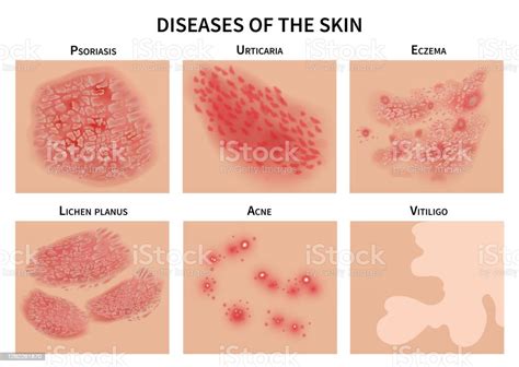Skin Diseases Derma Infection Eczema And Psoriasis Dermatology Vector