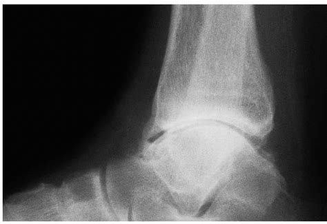 Arthroscopic Treatment Of Ankle Osteophytes And Osteochondral Lesions