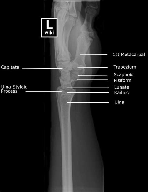Radiographic Anatomy Wrist Lateral With Images Radiology