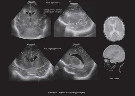 Cranial Ultrasound Findings In Preterm Germinal Matrix Haemorrhage