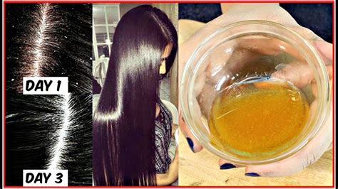 Apply This Mixture On Your Scalp To Get Rid Of Dandruff For Ever Anti