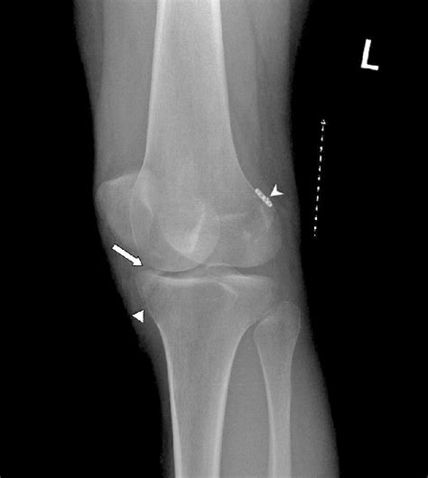 This set is often saved in the same folder as. b: Lateral Oblique Knee View Moderate joint effusion is ...