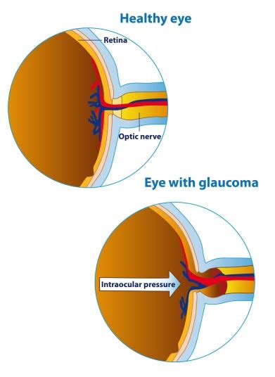 Glaucoma Test · Top Eye Doctors Specialists In Nyc · Optometrist