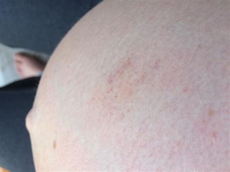 I Have A Bruise On My Pregnant Belly Pregnantbelly