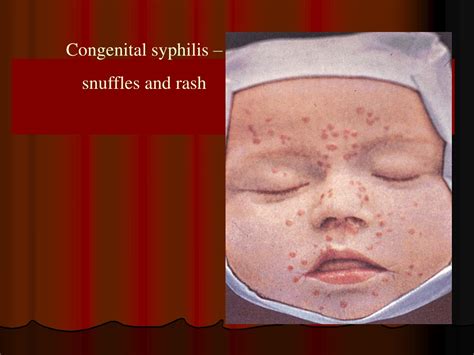 Ppt Tertiary And Congenital Syphilis Principles Of Therapy And