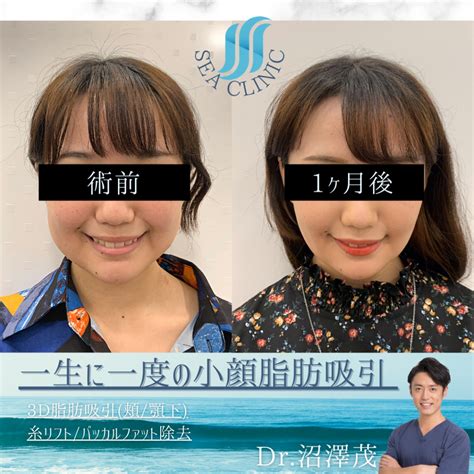 一生に一度の小顔脂肪吸引 Sea Clinic −シークリニック 銀座― 理想を叶える小顔治療