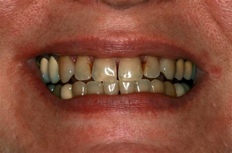 Are Veneers An Option For Discolored Teeth