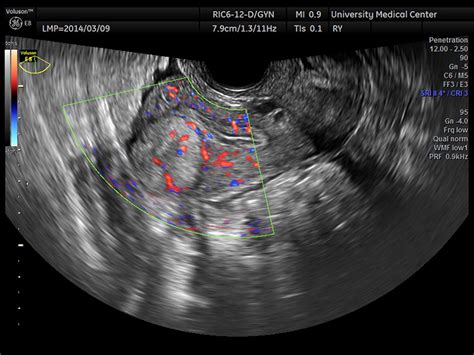 Diagnosis And Management Of An Adenomatoid Uterine Tumor Ultrasound