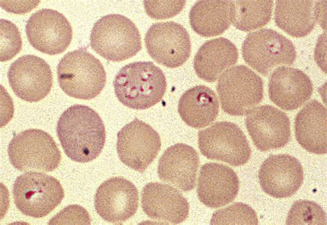 Babesiosis Cases Likely On The Rise Outbreak News Today