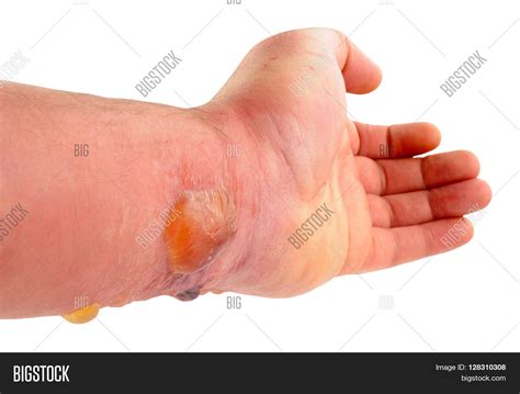 Arm Blisters Caused By Image And Photo Free Trial Bigstock