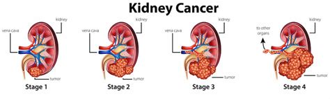 Renal Cell Carcinoma Types