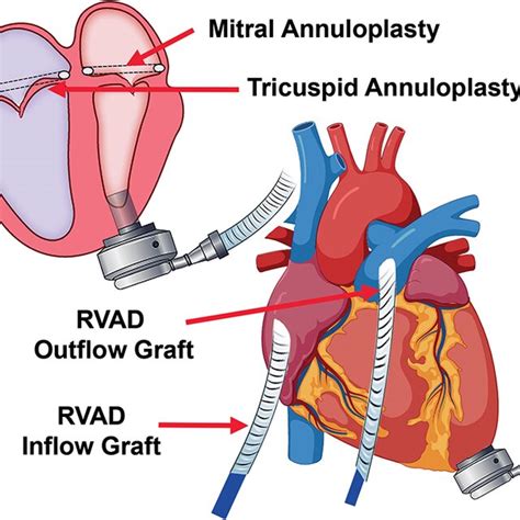 Concomitant Mitral And Tricuspid Valve Repair With Biventricular Assist