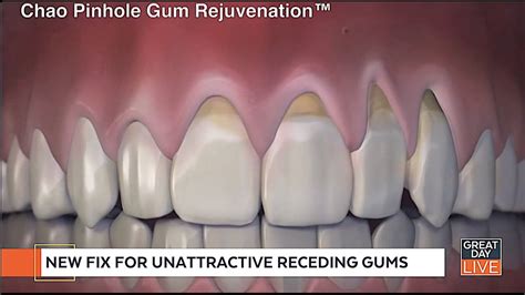 Reverse Receding Gums Grow Back Receding Gums Gum Recession Treatment