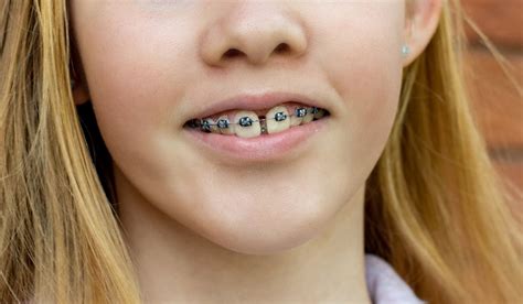 How Do Braces Treat Gaps In Teeth And Do They Come Back Cavitiesgetaround