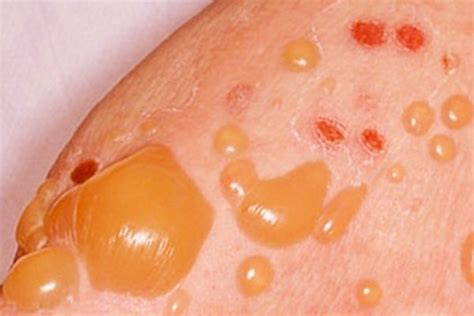 Bullous Pemphigoid Is A Rare Skin Disorder Characterised By The