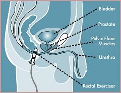 Treat your Urinary Incontinence with Liberty® Pelvic Floor Electrical