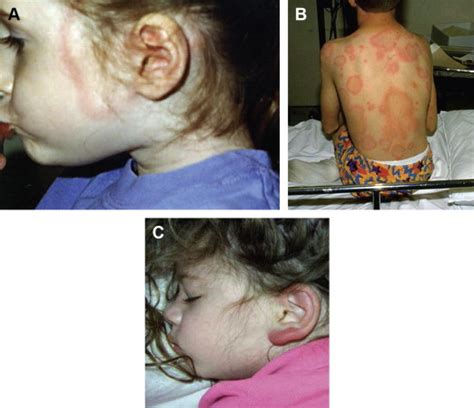 Lyme Disease In Children Infectious Disease Clinics